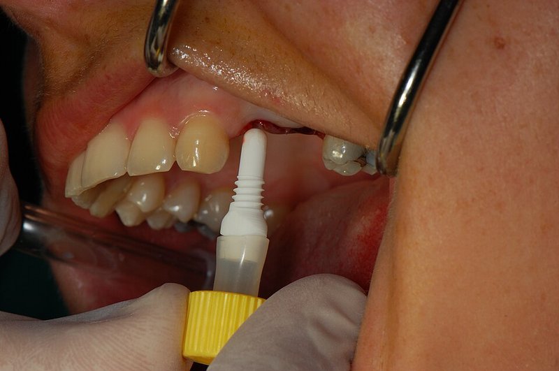 Mouthguards